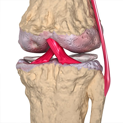 Gilbert Osteoarthritis Treatment