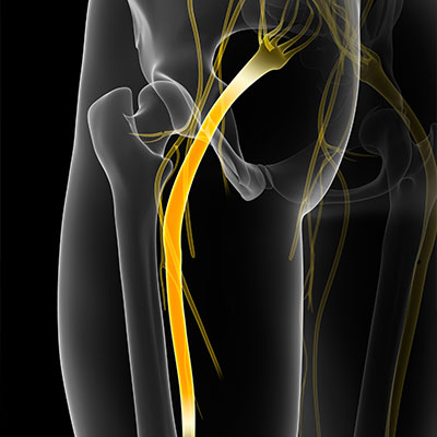 Sciatica Treatment in Gilbert