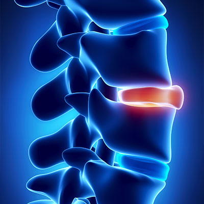 Slipped Disc Treatment in Gilbert